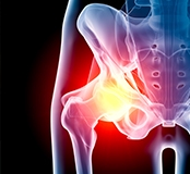 Hip Arthritis