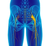 Sciatica