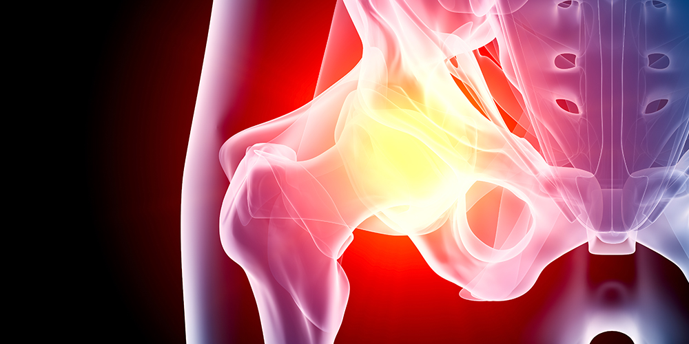 Hip Arthritis - Pic