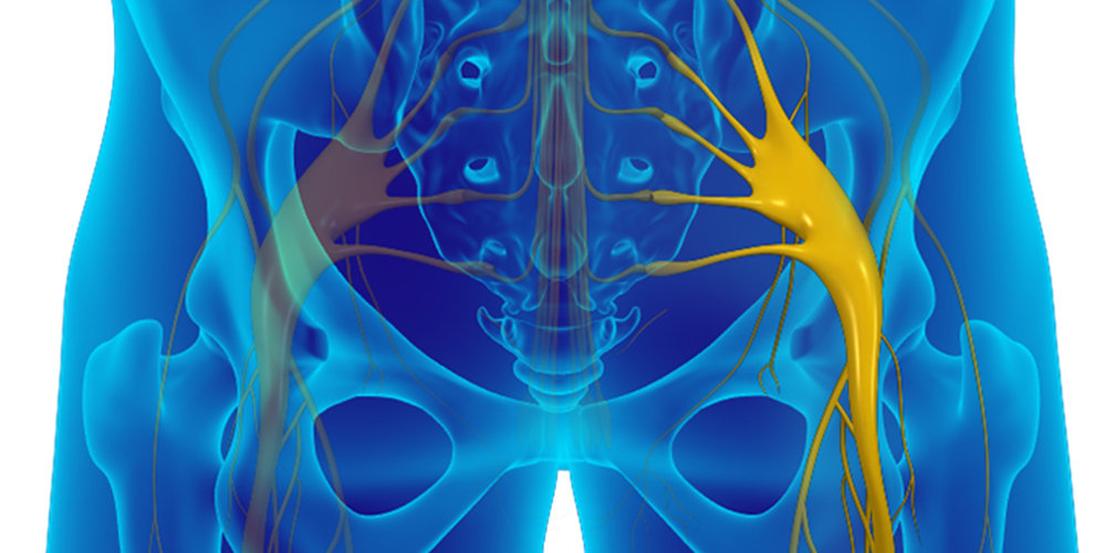 Sciatica - Pic