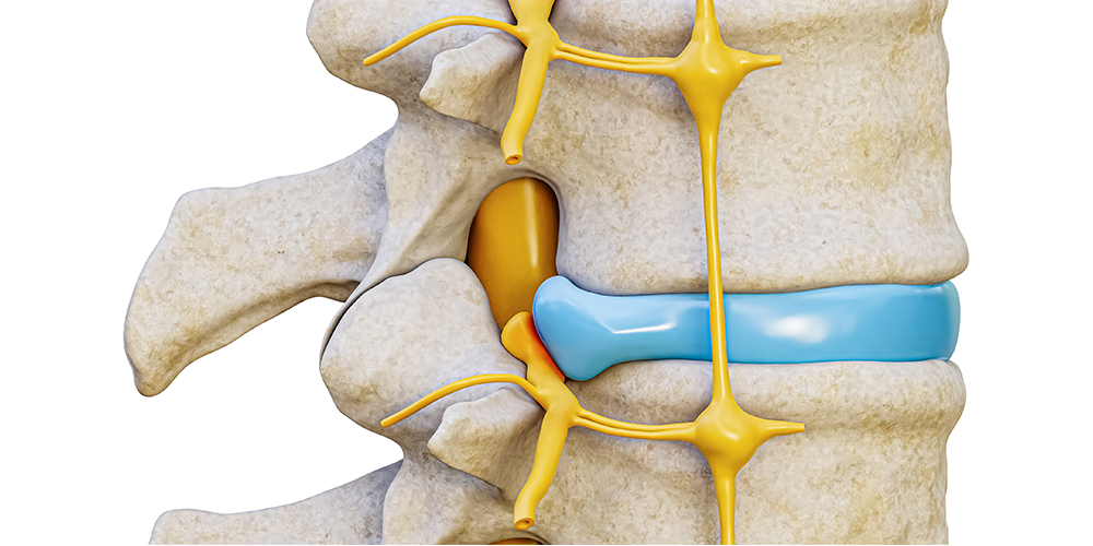 Difference Between A Bulging Disc And A Herniated Disc - Pic